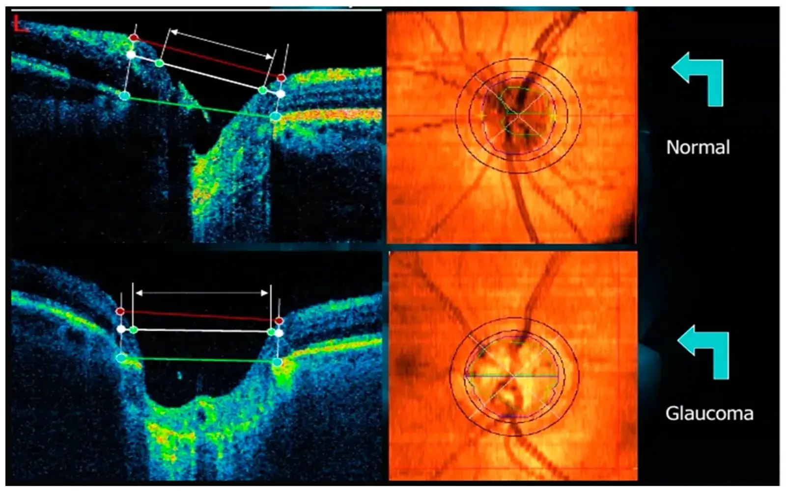 Imagem mostrando abaixo a alteração no exame de OCT ocasionada pelo glaucoma. Há aumento da escavação e perda da camada de fibras nervosas.