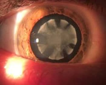 Catarata traumática: de evolução rápida.