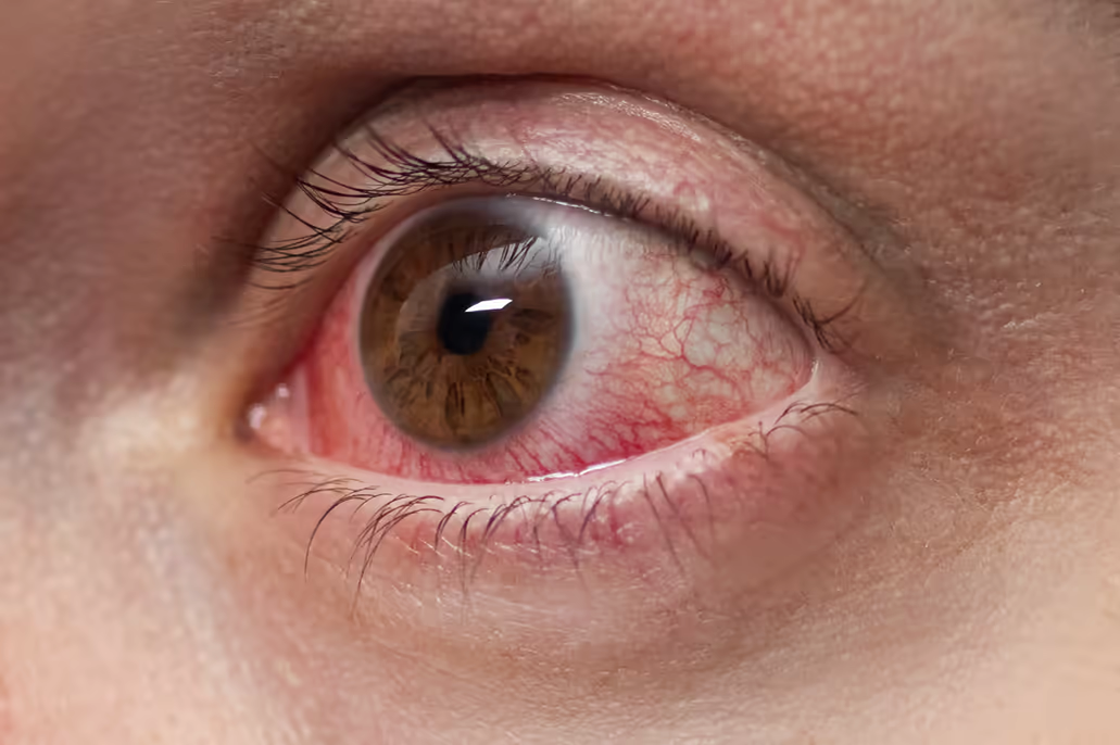 Close-up de olho com hiperemia conjuntival intensa — quadro típico de alergia ocular ativa.
