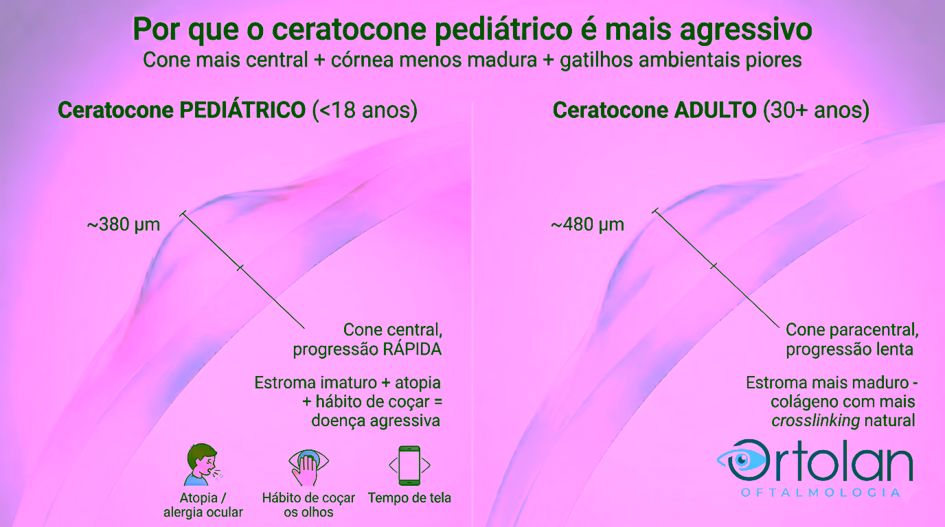 Comparativo anatômico 3D entre ceratocone adulto (esquerda - cone paracentral, ~480 µm no ápice, progressão lenta, estroma maduro) e ceratocone pediátrico (direita - cone mais central, ~380 µm no ápice, progressão rápida, estroma imaturo + atopia + hábito de coçar). Embaixo, ícones dos 3 gatilhos ambientais: alergia ocular, hábito de coçar os olhos, tempo de tela.