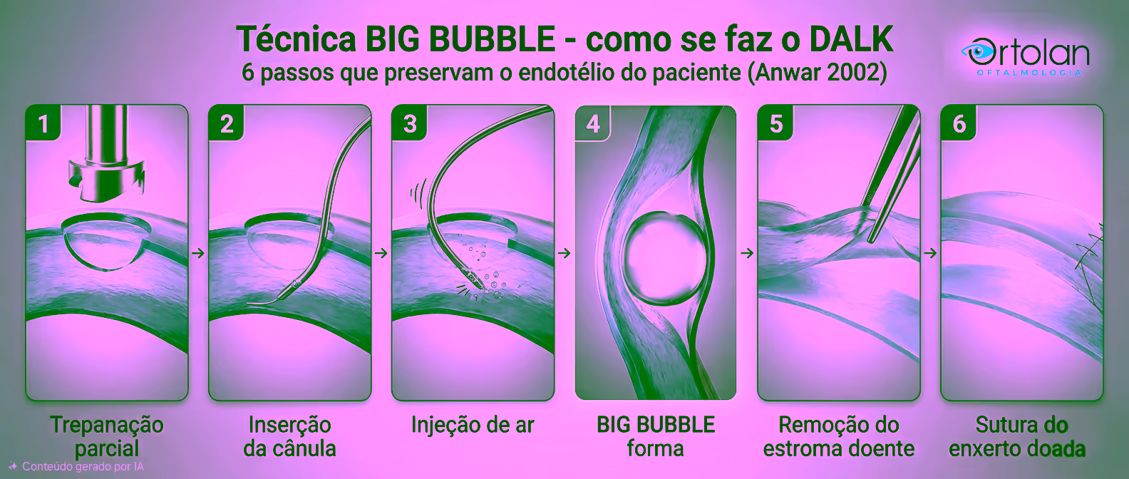 Strip horizontal de 6 painéis ilustrando passo a passo a técnica big bubble do DALK (Anwar 2002): 1) trepanação parcial da córnea, 2) inserção da cânula no estroma profundo, 3) injeção de ar, 4) formação da BIG BUBBLE entre estroma e membrana de Descemet, 5) remoção do estroma doente, 6) sutura do enxerto doador sobre a Descemet preservada do paciente.