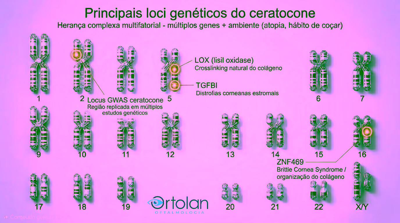 Cariótipo humano completo (cromossomos 1-22 + X/Y) destacando os 4 principais loci associados ao ceratocone: LOX (lisil oxidase, crosslinking natural do colágeno), TGFBI (distrofias corneanas estromais), ZNF469 (Brittle Cornea Syndrome / organização do colágeno), e locus GWAS do ceratocone (região 2q21.3, replicada em múltiplos estudos genéticos). Herança complexa multifatorial - múltiplos genes interagem com ambiente (atopia, hábito de coçar).