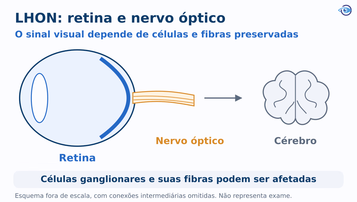 Esquema educativo mostra células ganglionares na retina e suas fibras formando o nervo óptico, que conduz sinais visuais ao cérebro. Fora de escala. Esquema educativo mostra células ganglionares na retina e suas fibras formando o nervo óptico, que conduz sinais visuais ao cérebro. Fora de escala.