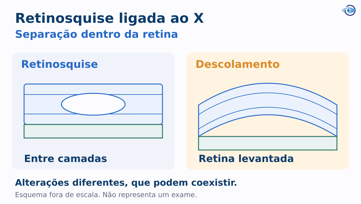 Comparação educativa entre retinosquise, com separação dentro da retina, e descolamento, com levantamento da retina em relação ao suporte. Esquema fora de escala. Comparação educativa entre retinosquise, com separação dentro da retina, e descolamento, com levantamento da retina em relação ao suporte. Esquema fora de escala.
