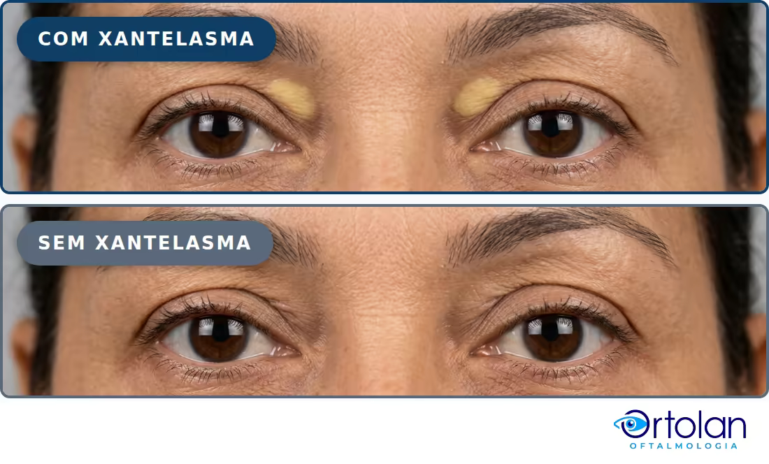 Comparação didática do aspecto da pálpebra com as placas amareladas de xantelasma no canto interno das pálpebras superiores e sem elas.
