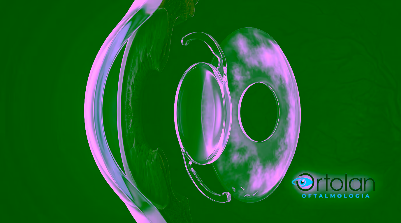 Ilustração 3D em corte do olho depois da capsulotomia: a lente intraocular segue intacta e a cápsula posterior atrás dela agora tem uma janela circular aberta no centro, por onde a luz passa livre até a retina.