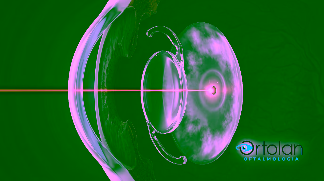 Ilustração 3D em corte do olho durante a capsulotomia: o feixe do laser Nd:YAG atravessa a lente intraocular transparente sem danificá-la e converge num único ponto de foco atrás dela, sobre a cápsula posterior opaca.