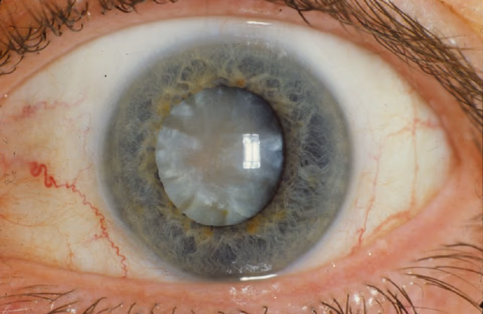 Cirurgia de catarata