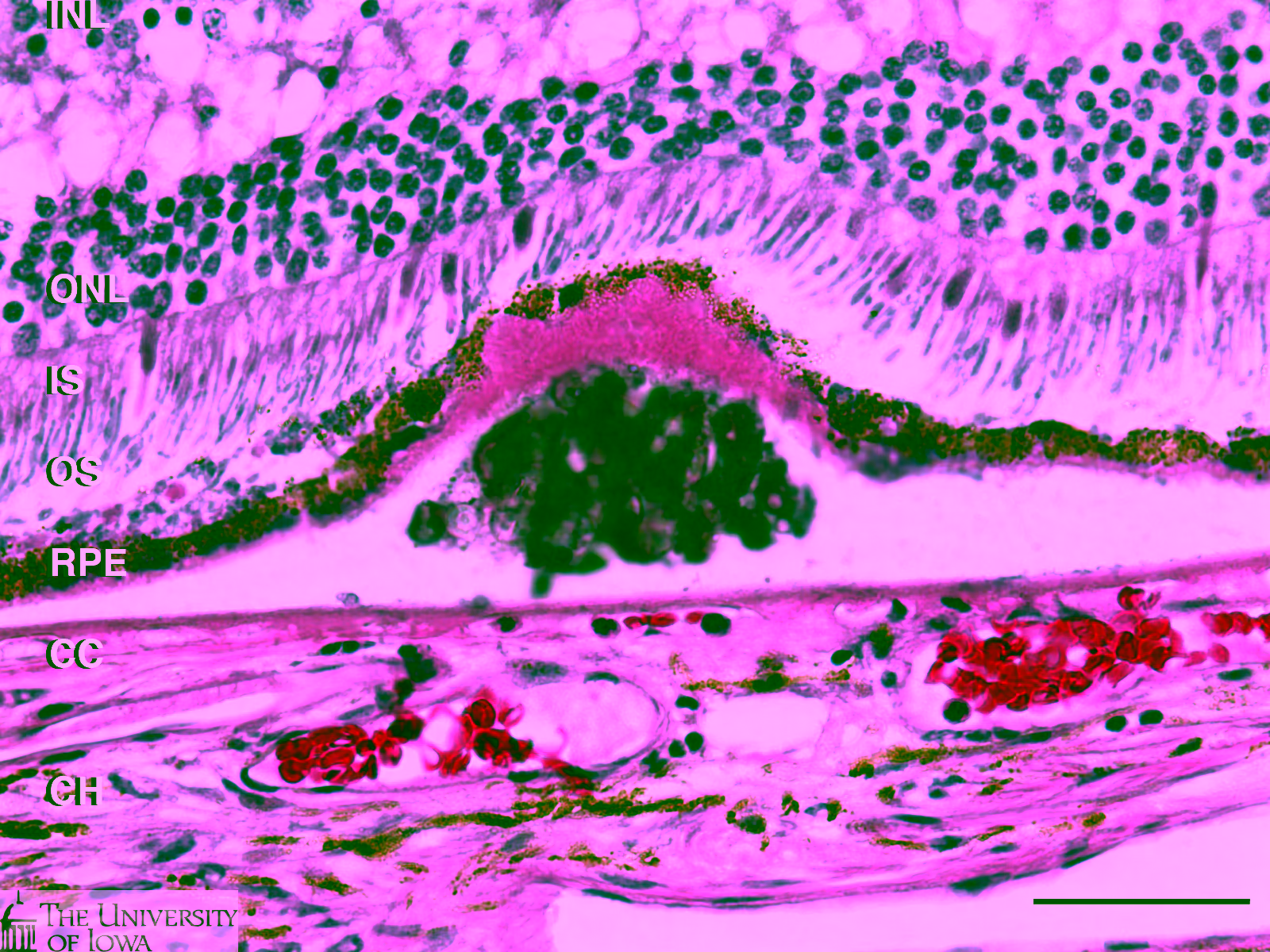 Corte histológico da retina humana, corado por H&E, mostrando uma drusa como depósito por baixo do epitélio pigmentar, com as camadas rotuladas de INL a coroide