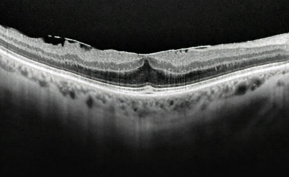 Membrana epirretiniana Membrana epirretiniana