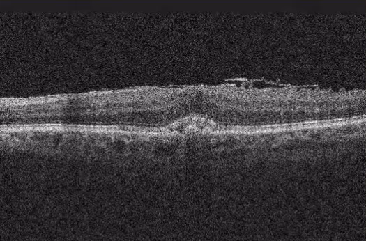 Outro exemplo de OCT com membrana epirretiniana, mostrando o enrugamento das camadas internas da retina.