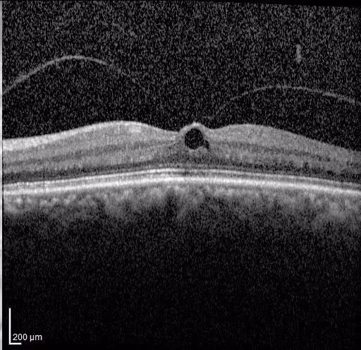 OCT de buraco macular pequeno no olho esquerdo.