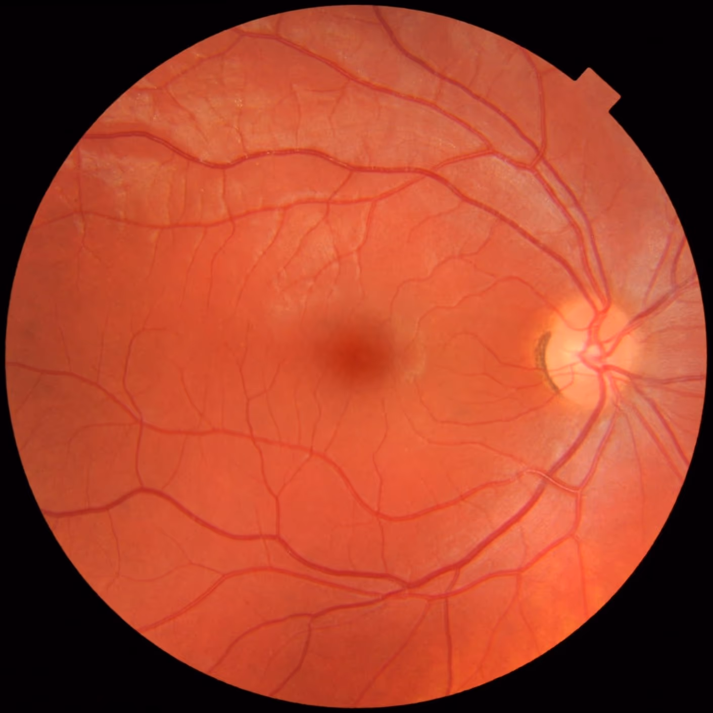 Retinografia de fundo de olho normal, mostrando a mácula, o nervo óptico e os vasos retinianos.