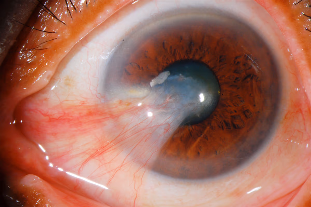 Pterígio avançado invadindo o eixo pupilar.