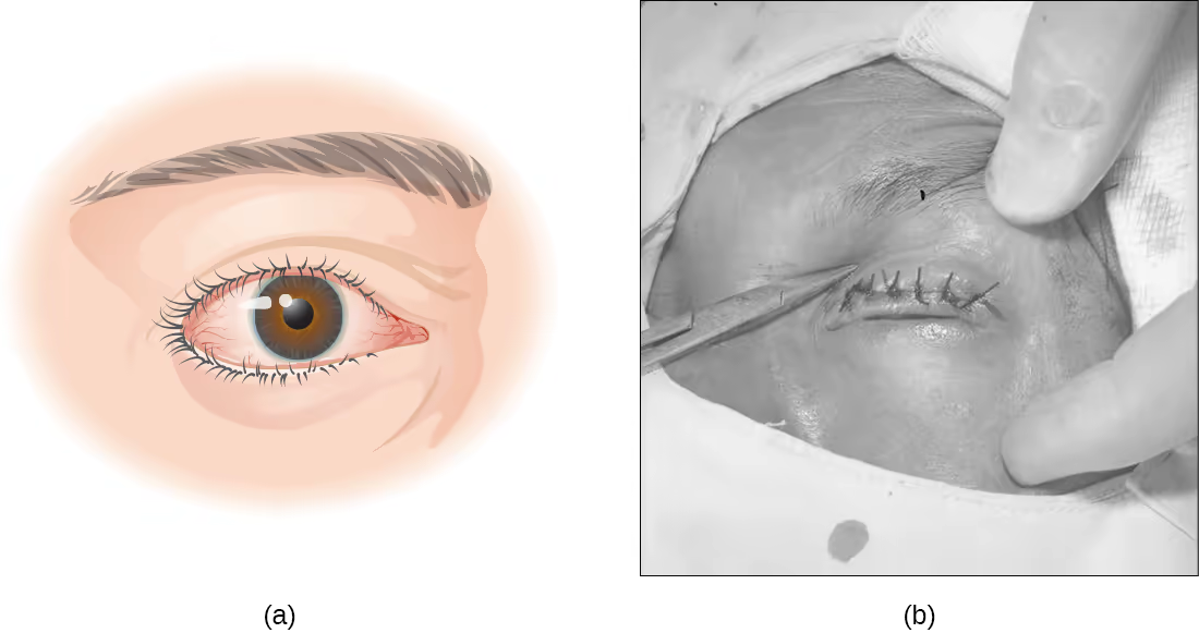 Closeup ocular mostrando triquíase — cílios desviados crescendo em direção à superfície da córnea, com hiperemia conjuntival. Closeup ocular mostrando triquíase — cílios desviados crescendo em direção à superfície da córnea, com hiperemia conjuntival.