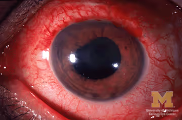 Olho com uveíte anterior — hiperemia periceratica (ciliary flush) ao redor da córnea e pupila irregular por sinéquias. Olho com uveíte anterior — hiperemia periceratica (ciliary flush) ao redor da córnea e pupila irregular por sinéquias.