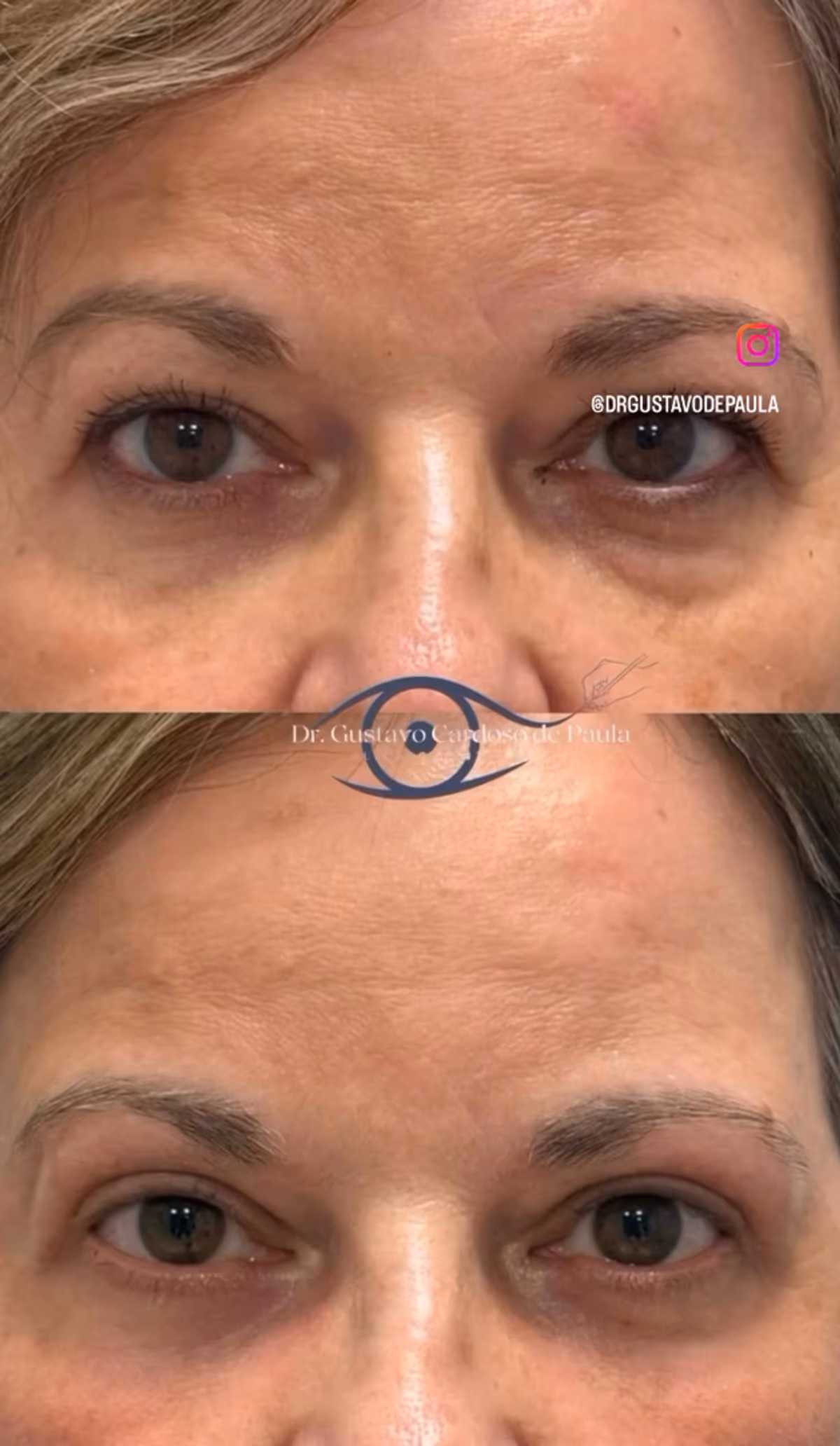 Sequência de três tempos — retração de pálpebra superior esquerda por Orbitopatia de Graves, pós-operatório imediato e no 7º dia.