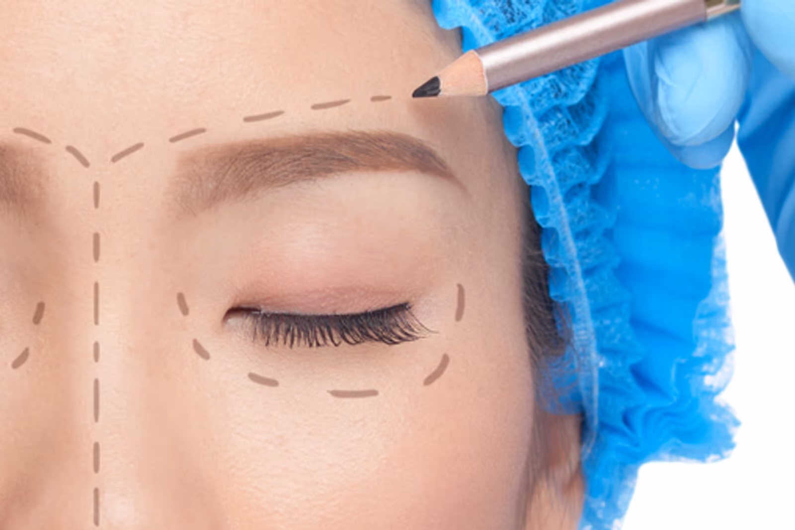 Close-up de uma pessoa com marcações pré-operatórias ao redor das pálpebras antes de uma cirurgia palpebral.