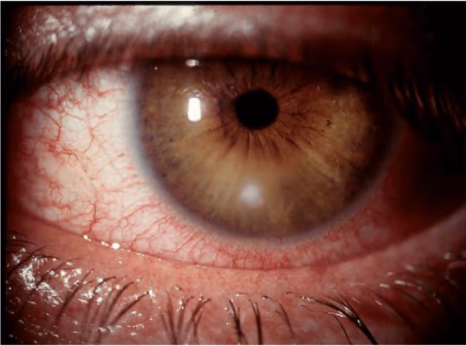 Úlcera de Córnea por mal uso de Lentes de Contato. Note o ponto branco na córnea do paciente além do olho vermelho e irritado.