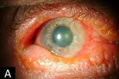 Ceratoconjuntivite Atópica (conjuntivite atópica com lesão de córnea). Note a inflamação da pálpebra superior e inferior associada.