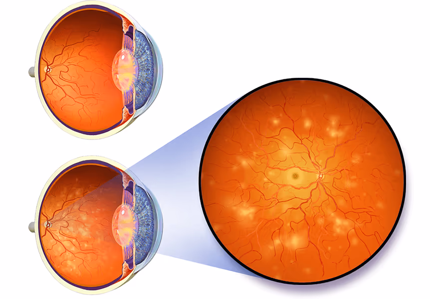 Foto mostrando sinais da retinopatia diabética como exsudatos algodonosos no fundo de olho. Foto mostrando sinais da retinopatia diabética como exsudatos algodonosos no fundo de olho.