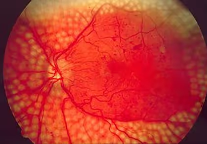 Foto mostrando fotocoagulação da retina para tratamento da retinopatia diabética. Foto mostrando fotocoagulação da retina para tratamento da retinopatia diabética.