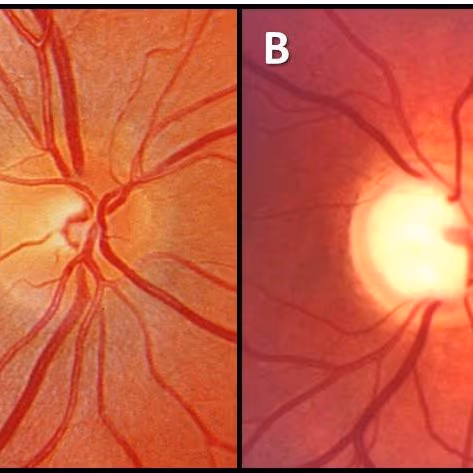 Imagem de Retinografia mostrando o aumento da escavação do nervo óptico (B) em relação o olho normal (A).