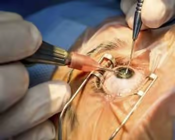 Cirurgia de Facoemulsificação (Cirurgia de Catarata) em andamento.