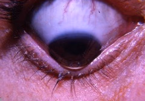 Implante de Lente Fácica