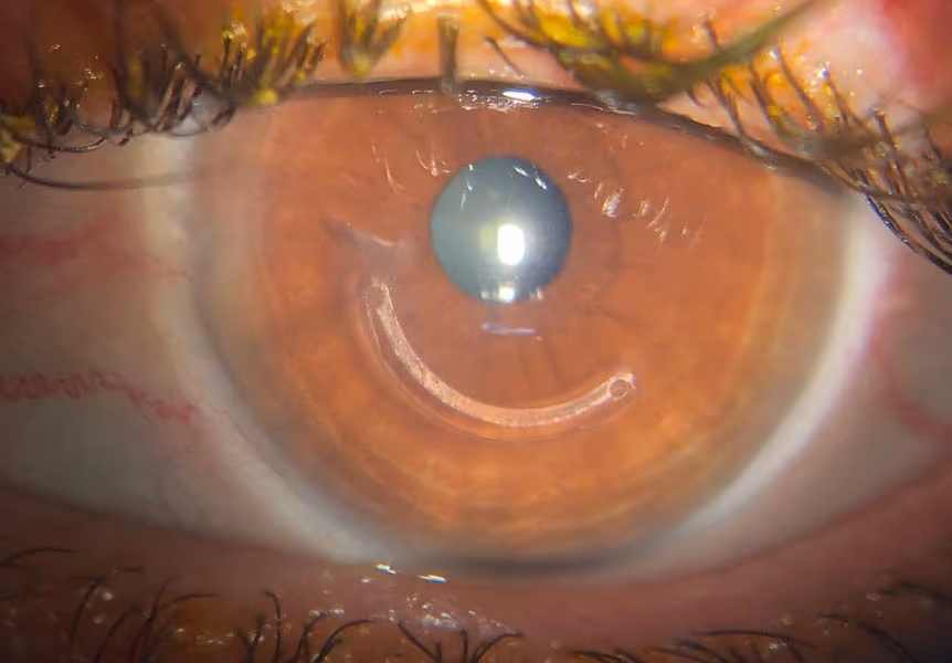 Implante de Anel Intraestromal (Keraring e Anel de Ferrara)