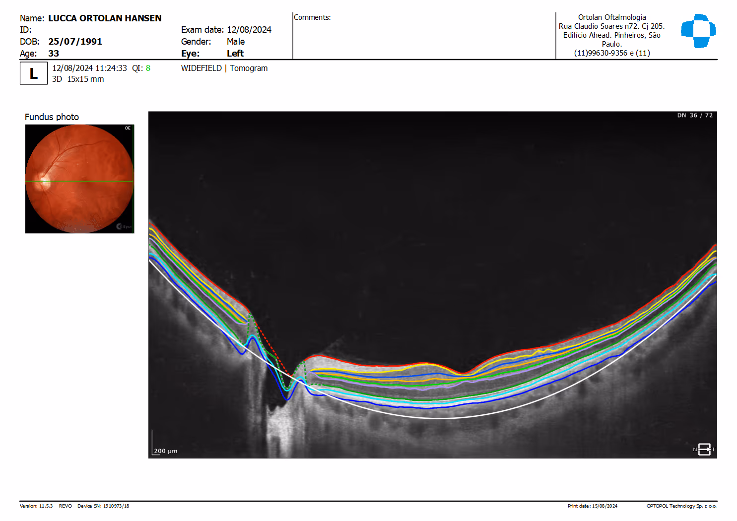 Imagem de seção da retina obtida pelo OCT mostrando as camadas da retina e o nervo óptico.