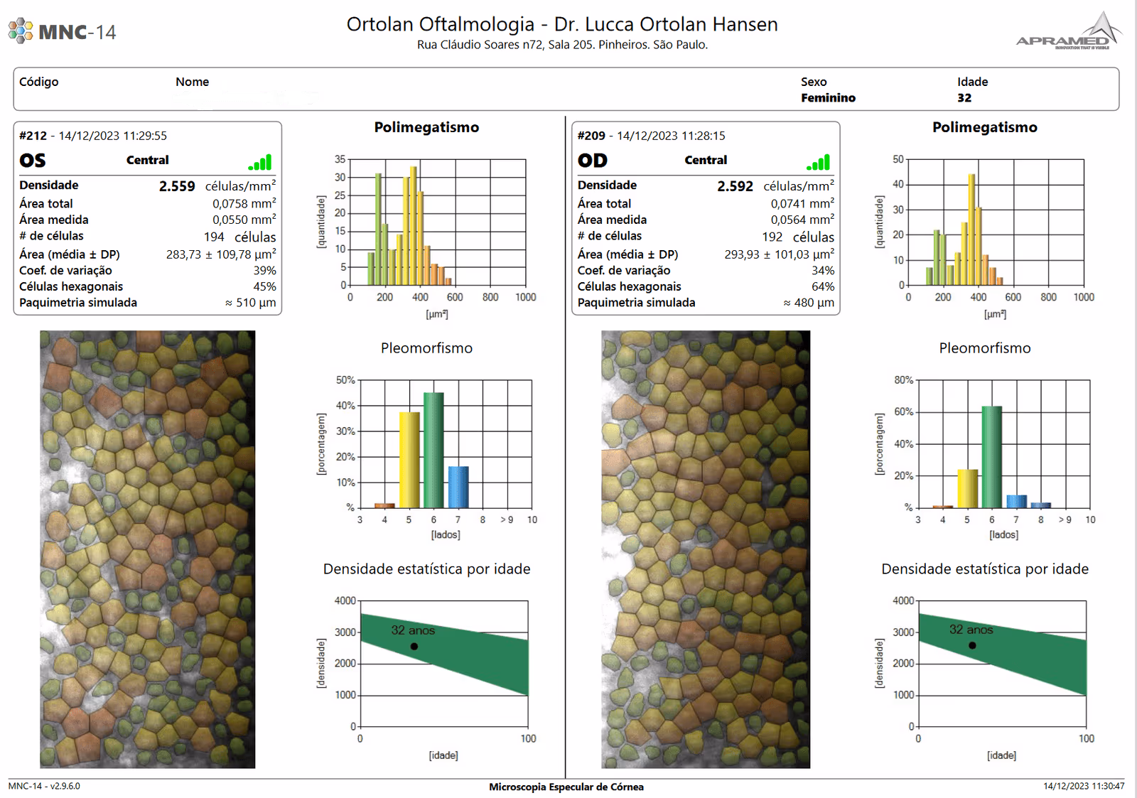 Microscopia Especular de Córnea: exame que avalia as células do endotélio da córnea.