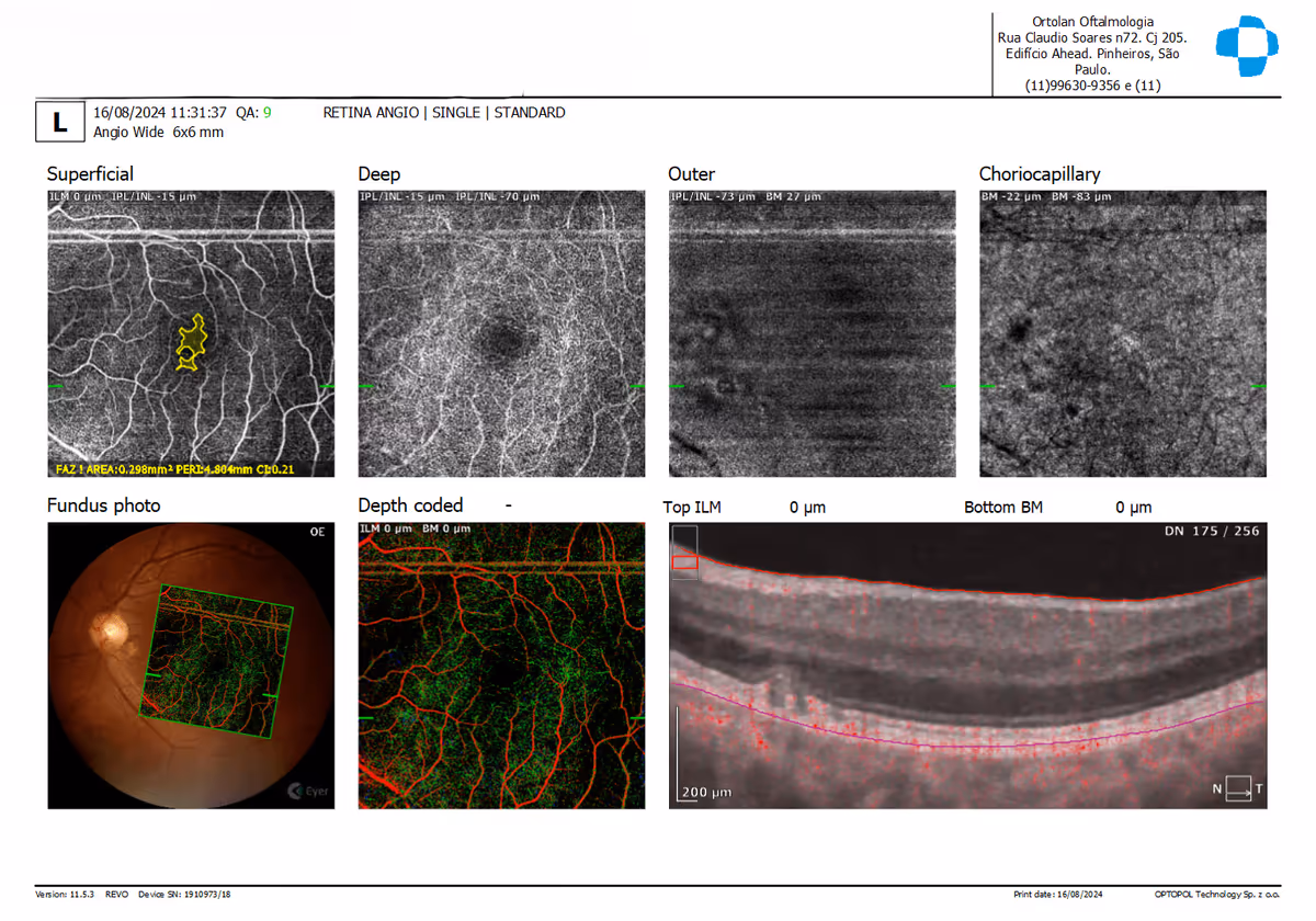 Estudo dos vasos da retina por Angio-OCT em caso de drusas e degeneração macular.
