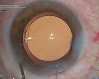 Exemplo de Lente Tórica que também é Multifocal implantada em um olho de um paciente. Exemplo de Lente Tórica que também é Multifocal implantada em um olho de um paciente.