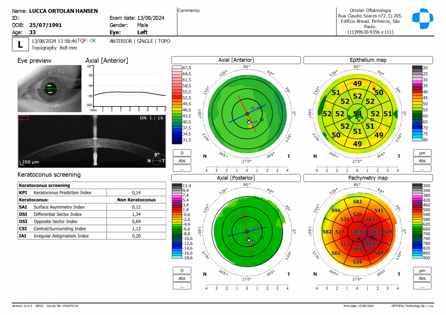 Análise da córnea por Tomografia de Coerência Óptica do segmento anterior.