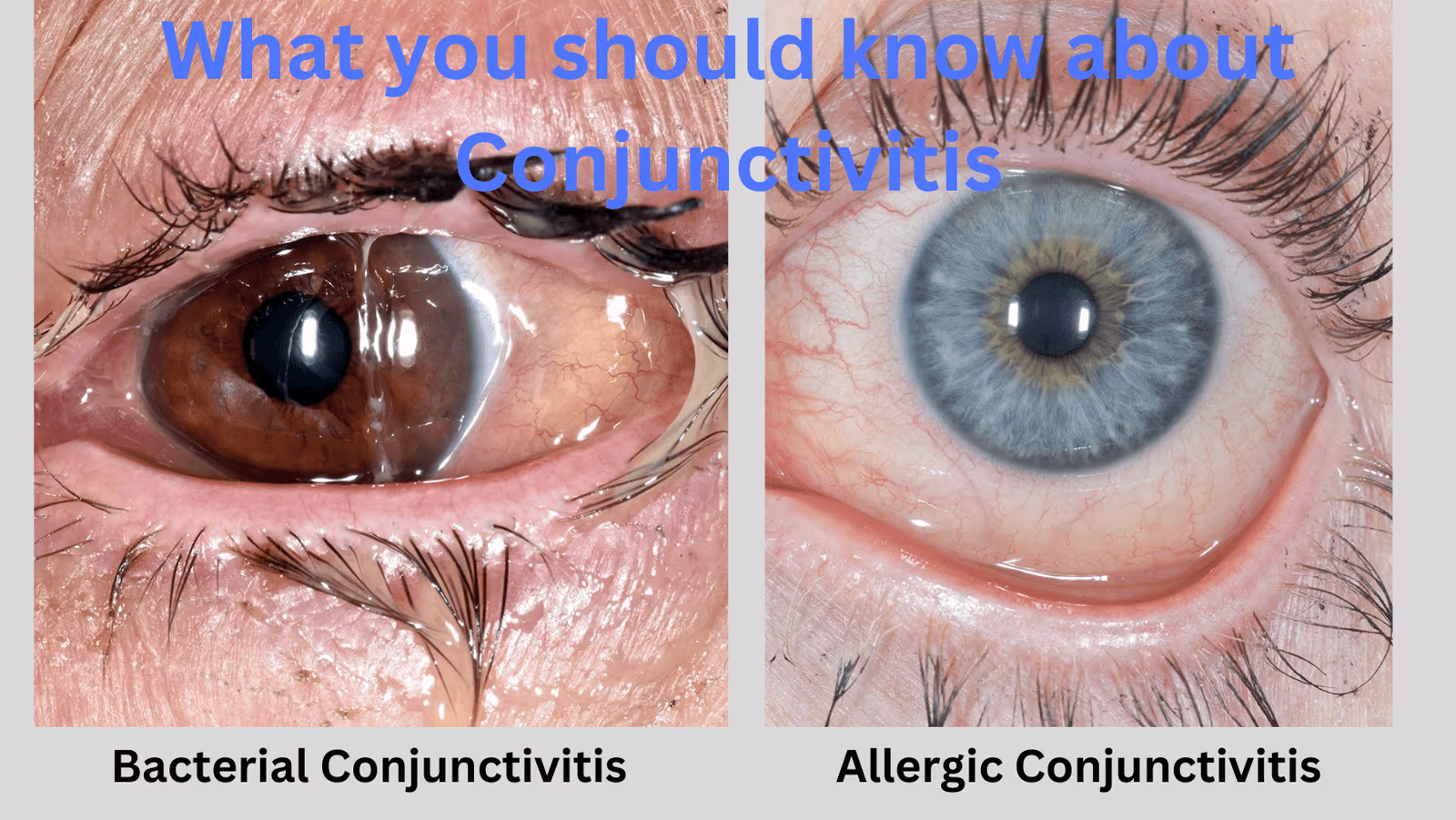 Veja à esquerda conjuntivite bacteriana e à direita a conjuntivite alérgica. O aspecto e a secreção são bem diferentes para o médico oftalmologista.