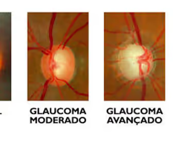 Imagem mostrando o aumento da escavação do nervo óptico no glaucoma.