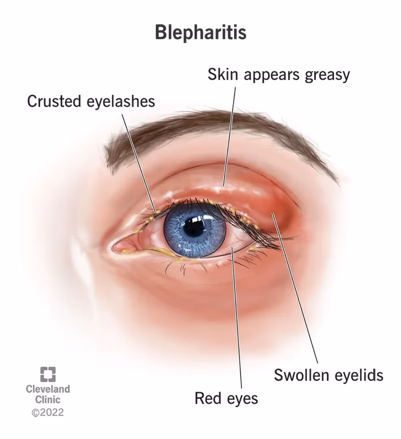 Sintomas de blefarite em close — pálpebras vermelhas e cílios com crostas.