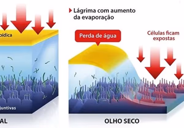 Foto mostrando como é a superfície ocular no olho seco. Foto mostrando como é a superfície ocular no olho seco.