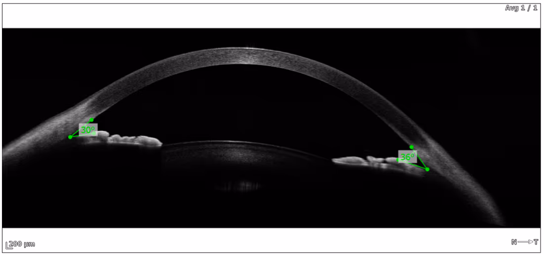 Imagem de OCT mostrando a câmara anterior do olho, a córnea, a íris e o cristalino.