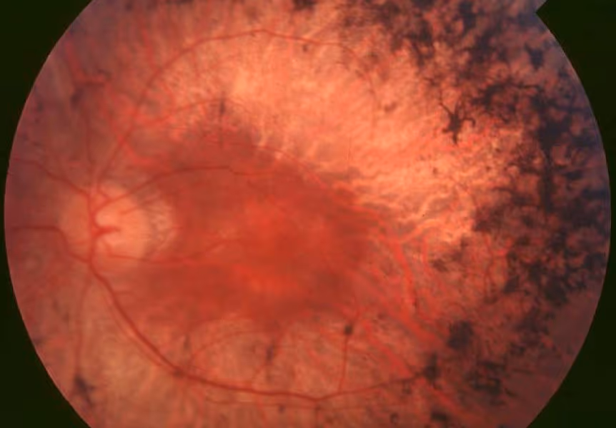 Foto de paciente com retinite pigmentar (retinose pigmentar). Foto de paciente com retinite pigmentar (retinose pigmentar).