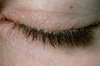 Blefarite com colarettes, típica na infestação pelo ácaro Demodex.