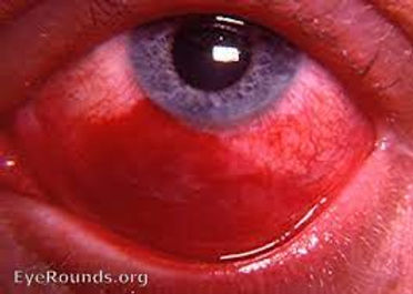 Conjuntivite traumática ocasionada por lesão direta à conjuntiva como por arranhão, soco, pancada, trauma com rolhas de espumante e afins.