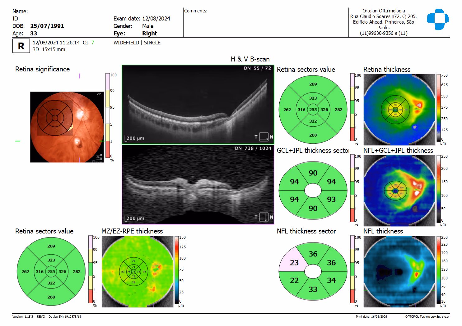 OCT correlaciona a Retinografia (foto de fundo de olho) que mostra uma atrofia corriorretiniana com o B-SCAN do OCT demonstrando atrofia total da retina e parte da coróide pontualmente. OCT correlaciona a Retinografia (foto de fundo de olho) que mostra uma atrofia corriorretiniana com o B-SCAN do OCT demonstrando atrofia total da retina e parte da coróide pontualmente.