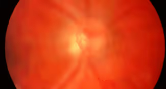 O descolamento do vítreo posterior é uma condição fisiológica que ocorre em pacientes com mais de 40-60 anos e pode estar associada ao descolamento de retina regmatogênico, ao aparecimento de moscas volantes e ao buraco de mácula. O descolamento do vítreo posterior é uma condição fisiológica que ocorre em pacientes com mais de 40-60 anos e pode estar associada ao descolamento de retina regmatogênico, ao aparecimento de moscas volantes e ao buraco de mácula.