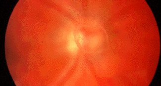 Moscas volantes (vitreous floaters) são alterações do vítreo do olho (gel interno).