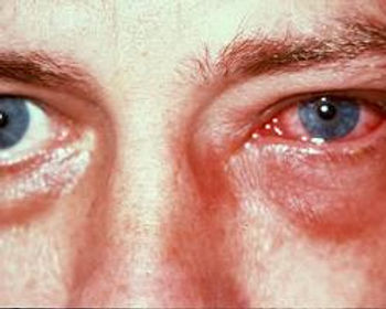 Conjuntivite Tóxica ou Conjuntivite Irritativa causada pela exposição à produtos químicos que irritam os olhos.