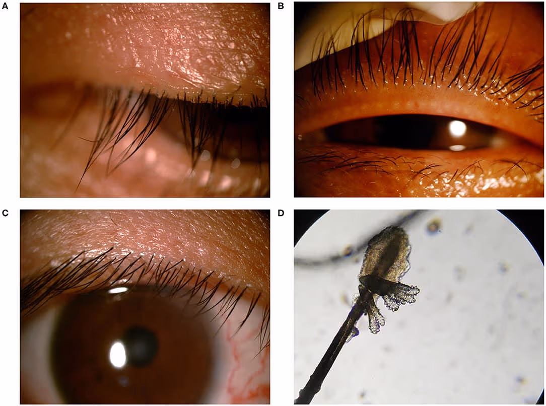 Achados clínicos da blefarite por Demodex.