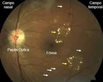 Exsudatos duros (depósitos de colesterol) em pacientes com retinopatia diabética ou retinopatia hipertensiva.