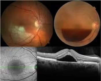 De cima pra baixo e da esquerda pra direita: oclusão de ramo de artéria central da retina, grande hemorragia pré-retiniana, retinografia mostrando coriorretinopatia central serosa, imagem de OCT mostrando coriorretinopatia central serosa.